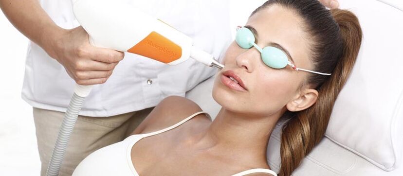 Laser azala birsortzea